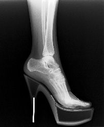 How to manage High Heel Pain
