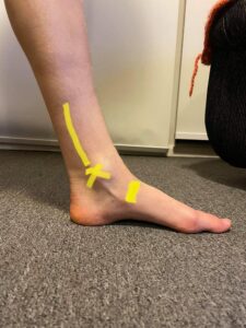 Medial ankle